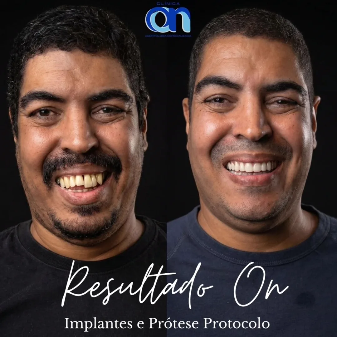 Antes e depois de implante dentário — paciente Clínica ON