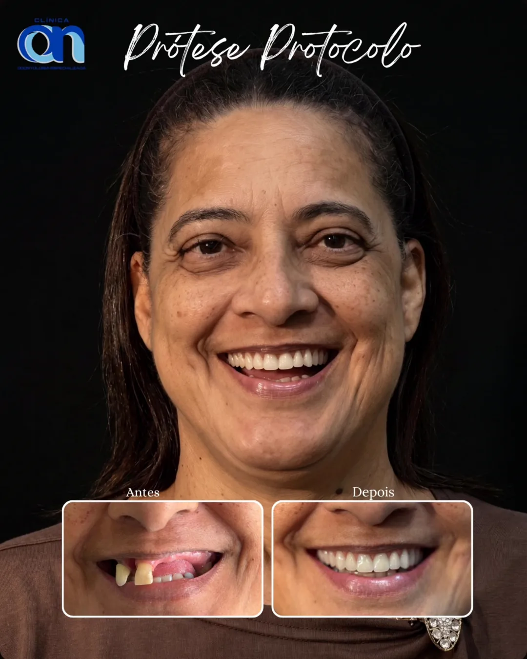 Antes e depois de prótese protocolo — paciente Clínica ON