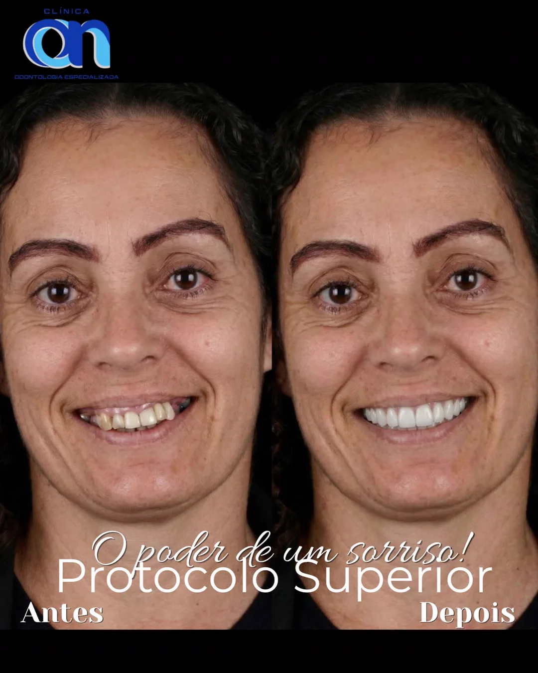 Antes e depois de protocolo superior — paciente Clínica ON