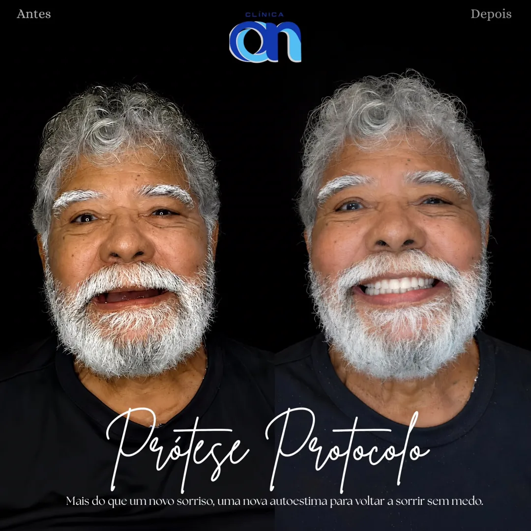 Antes e depois de prótese protocolo — paciente Clínica ON